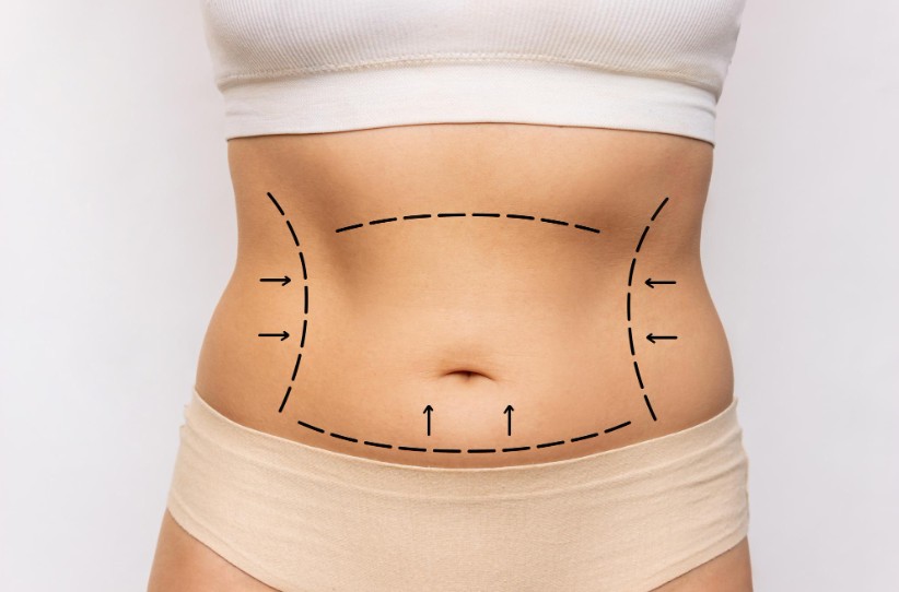 abdominoplastie